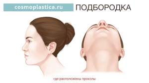 Где расположены хирургические доступы. Липосакция подбородка
