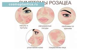 Проявления розацеа на лице
