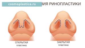 Методы проведения пластики носа. Где находится хирургический доступ