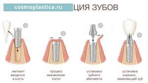 Этапы имплантации зубов