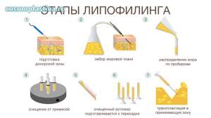 Этапы липофилинга. Как выполняется процедура
