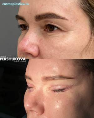 Эндоскопический лифтинг лица, круговая блефаропластика, костная пластика с липофилингом лица и комментариями в процессе и результатом после операции. Работа доктора Анны Петровны Першуковой