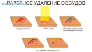 Как проводится лазерное удаление расширенных сосудов