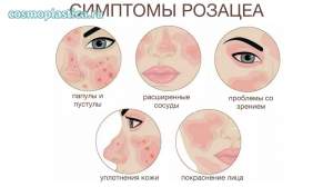 Проявления розацеа на лице