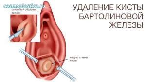 Как проводится удаление кисты бартолиновой железы
