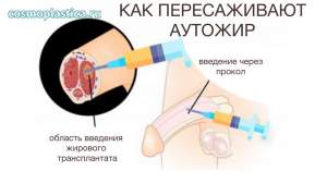Липофилинг полового члена. Как проводится пересадка аутожира