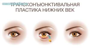 Трансконъюнктивальная нижняя блефаропластика