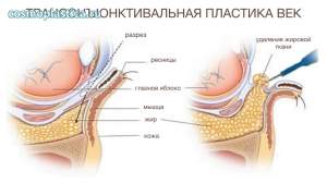 Доступ к жировым пакетам осуществляется через конъюнктиву