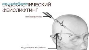 Что такое эндоскопический лифтинг через проколы