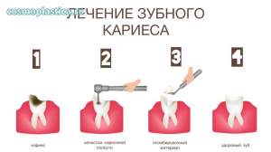 Как проводится лечение зубного кариеса