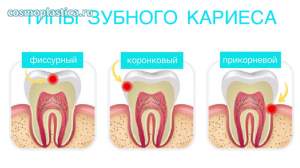 Каким бывает зубной кариес