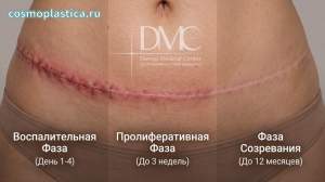 Как заживают постоперационные швы. основные этапы