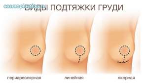 Методы подтяжки груди