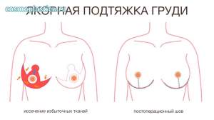 Что такое якорная подтяжка груди. Где расположен постоперационный шов