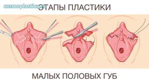 Как проводится пластика малых половых губ. Иссечение избыточной ткани