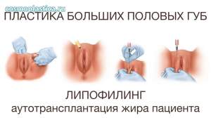 Как проводится увеличивающая липопластика больших половых губ