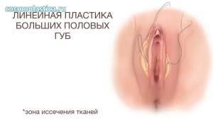 Что такое линейная пластика больших половых губ