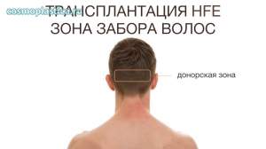 Откуда забирают волосы для трансплантации. Метод пересадки HFE