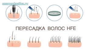 Пересадка волос HFE - самая эффективная и современная технология
