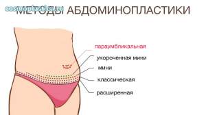 Пластика живота &ndash; методы проведения операции