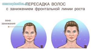 Женская пересадка волос в лобно-височную зону с занижением линии роста