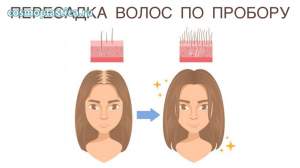Женская пересадка волос по пробору с загущением