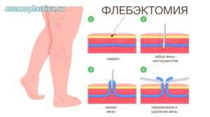 Как проводится флебэктомия