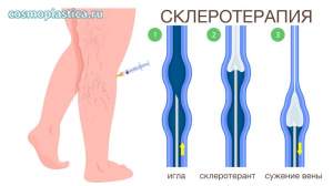 Суть склеротерапии, этапы процедуры