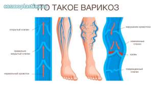 Что такое варикозное расширение вен