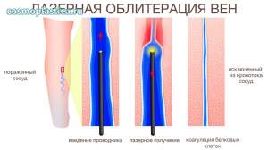 Что такое лазерная облитерация варикозных вен