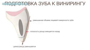 Установка 20-и керамических виниров e-Max: до и сразу после