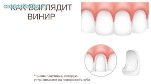 Установка 20-и керамических виниров e-Max: до и сразу после