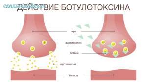 Ботулотоксин воздействует на пресинаптические нервные окончания, подавляя высвобождение ацетилхолина