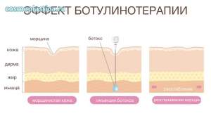 Какой эффект дает инъекция ботулотоксина