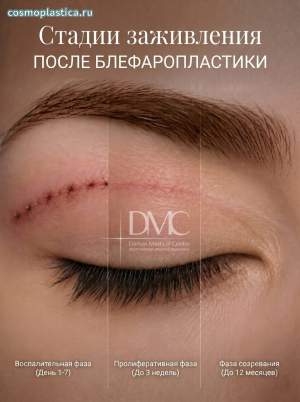 Как заживают швы после блефаропластики