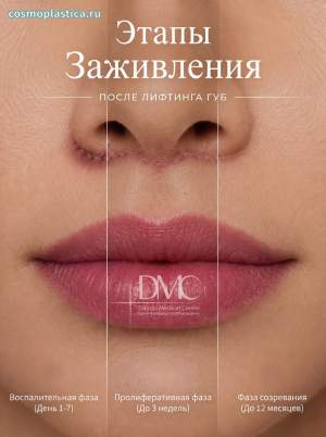 Как заживают швы после хейлопластики по методу БУЛХОРН