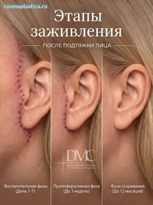 После подтяжки лица. Как заживают швы и где они расположены