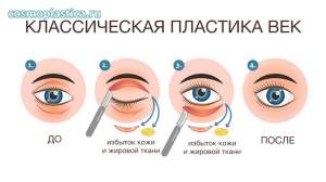 Что такое круговая пластика век. Коррекция верхнего и нижнего века