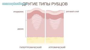 Как выглядят атрофические и нормотрофические рубцы