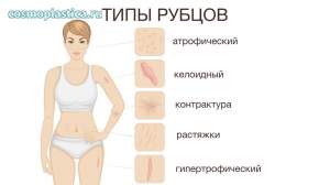 Какими бывают рубцы и шрамы