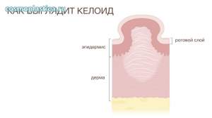 Что такое келоидный рубец