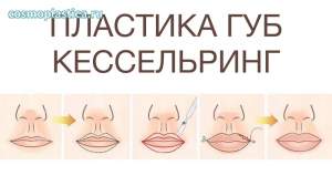 Хейлопластика по методу Кессельринга