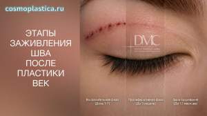 Как заживают швы после блефаропластики