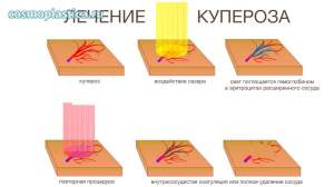 Лечение сосудистой сетки (расширенных сосудов)