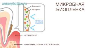 Биопленку образуют погруженные во внеклеточный матрикс и прикрепленные к поверхности зубов колонии микроорганизмов