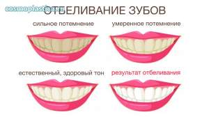 Какой результат дает профессиональное отбеливание зубов