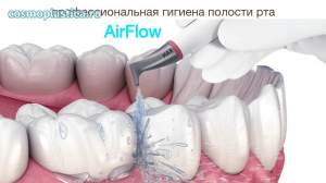 Что такое профессиональная гигиена полости рта по системе AirFlow