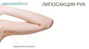 Где расположены хирургические доступы (проколы) при липосакции предплечий