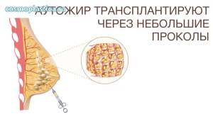 Липофилинг молочных желез - хирург работает через небольшие проколы, тонкими инструментами