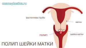Расположение полипа шейки матки